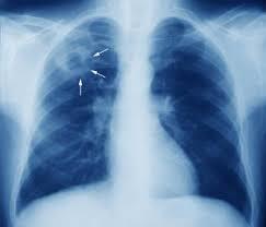 Tubercolosi: una malattia prevenibile e curabile ma anche una emergenza sanitaria ancora da temere